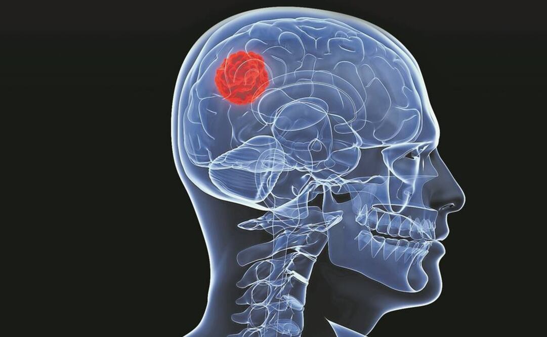 Los glioblastomas son muy resistentes a la radio y quimioterapia (ESPECIAL)