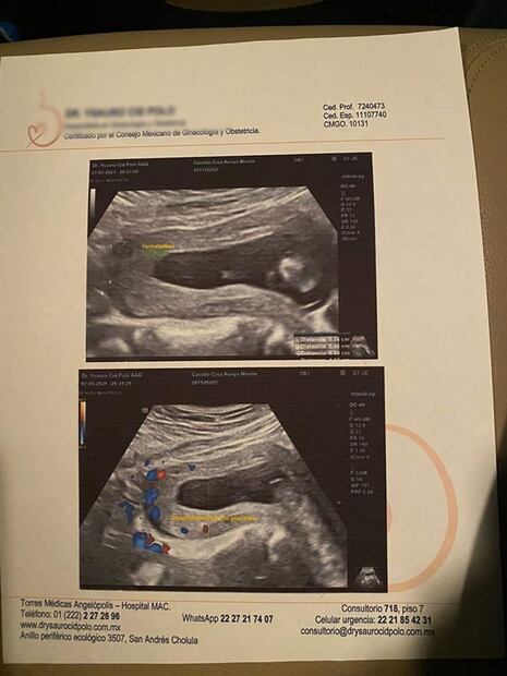 Mujer embarazada pide justicia tras sufrir golpiza por sobrino de candidata de Tlaxcala