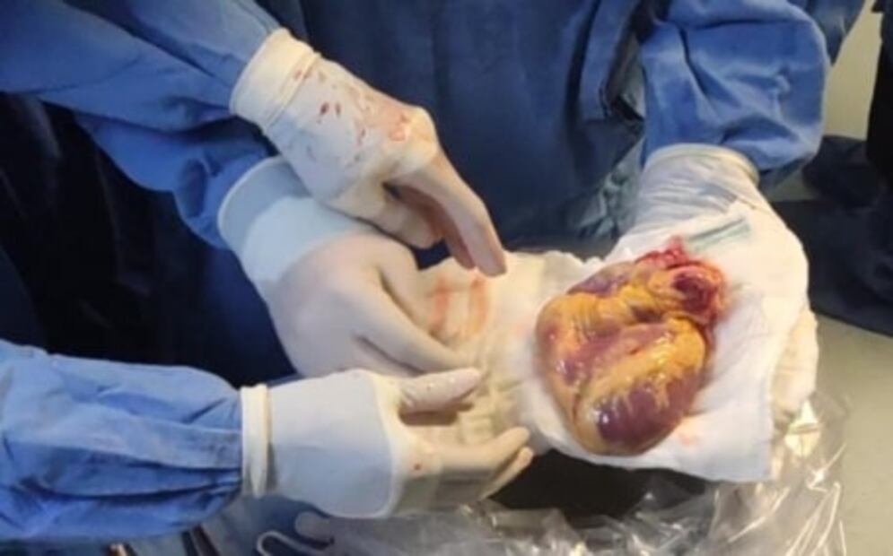 Joven albañil sufre muerte encefálica y familia salva la vida de 5 personas al donar sus órganos