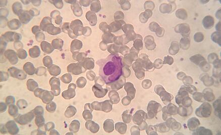 Una mutación genética, posible causante de la enfermedad del lupus 