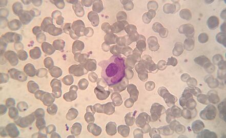 Una mutación genética, posible causante de la enfermedad del lupus