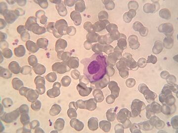 Una mutación genética, posible causante de la enfermedad del lupus