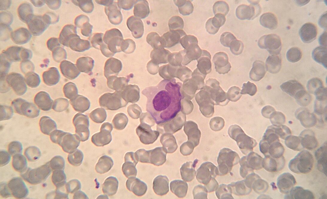 El primer marcador diagnóstico del lupus. Foto: Especial