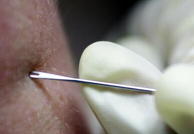 ¿Erupciones por viruela del mono dejan cicatrices? 