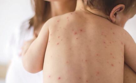 Descarta Secretaría de Salud de Edomex alerta por caso de sarampión 