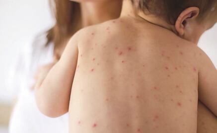 Descarta Secretaría de Salud de Edomex alerta por caso de sarampión 