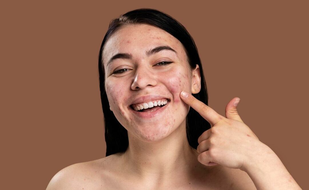 Hay muchos mitos sobre las causas del acné. Foto: Freepik