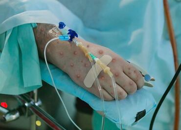 Viruela del mono: Ssa espera autorización de Cofepris para uso de emergencia de vacuna contra Mpox