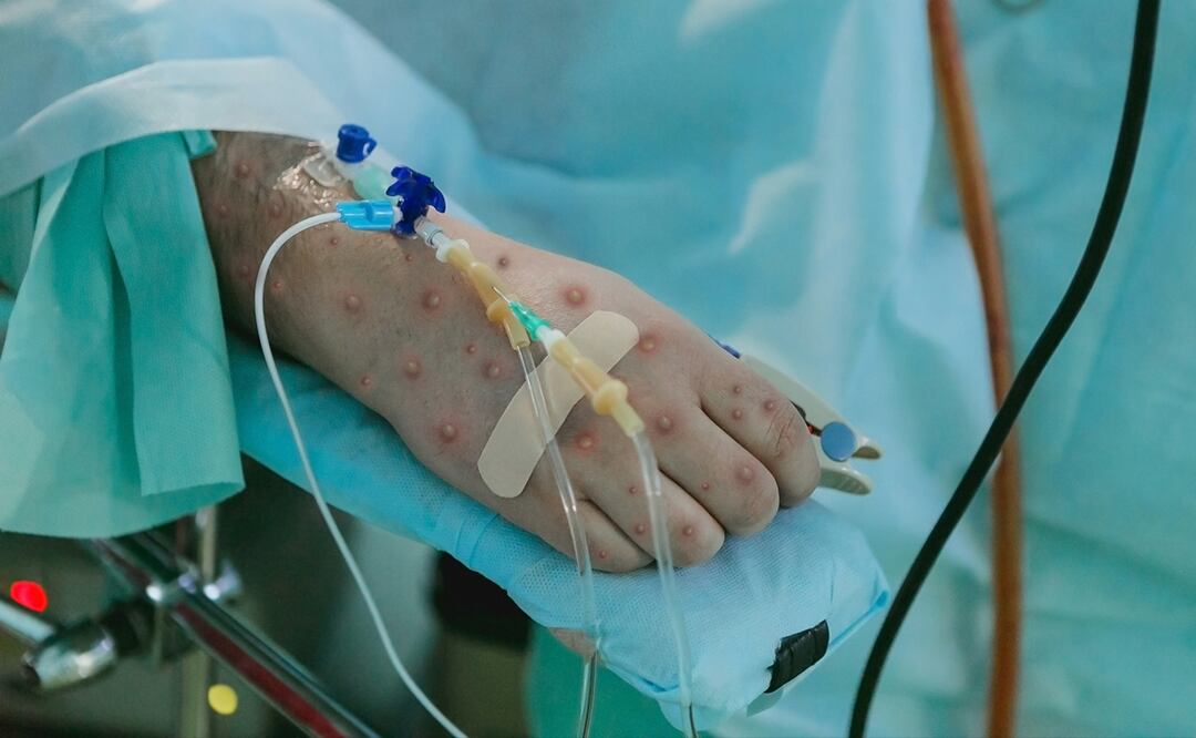 De acuerdo a las indicaciones de Ministerio de Salud, en Chile pueden acceder a las vacunas contra la Mpox personas que hayan tenido contacto con casos activos, trabajadores sexuales, pacientes de VIH, pacientes que hayan tenido o padezcan una infección de transmisión sexual. Foto: iStock.