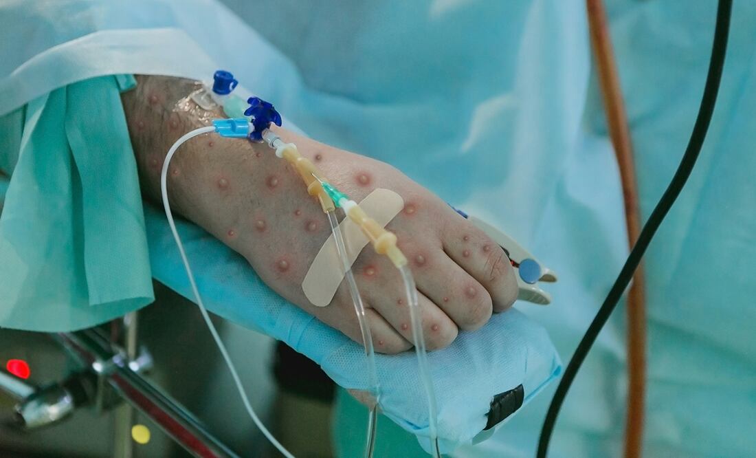 Lo que preocupa del actual brote es que se está observando que el clado 1b se contagia más fácilmente entre personas y tiende a causar síntomas más severos, si bien la OMS ha lanzado un mensaje de tranquilidad asegurando que el brote de mpox "no es la covid". Foto: iStock.