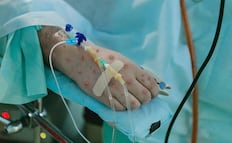 Viruela del mono: Ssa inicia capacitación sobre mpox a personal de salud; hay 61 casos confirmados en México