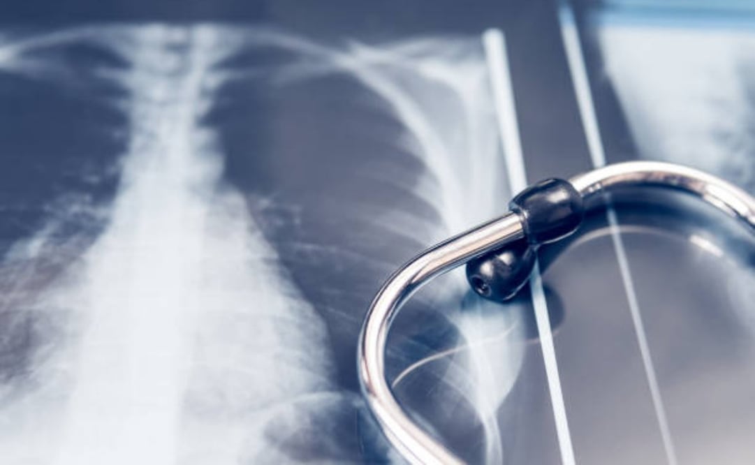 "Las radiografías constituyen una herramienta diagnóstica fundamental, con mayor peso aún en regiones donde los servicios especializados son escasos”, indica la CNA. Foto: iStock
