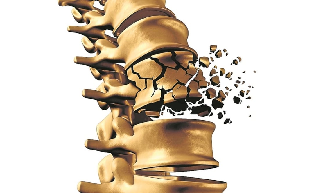 Las fracturas suelen ser más frecuentes en las vértebras, fémur, muñecas y cadera. (FOTO: Archivo/EL UNIVERSAL)