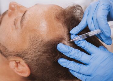 Las 3 mejores clínicas de injerto capilar en CDMX para 2025