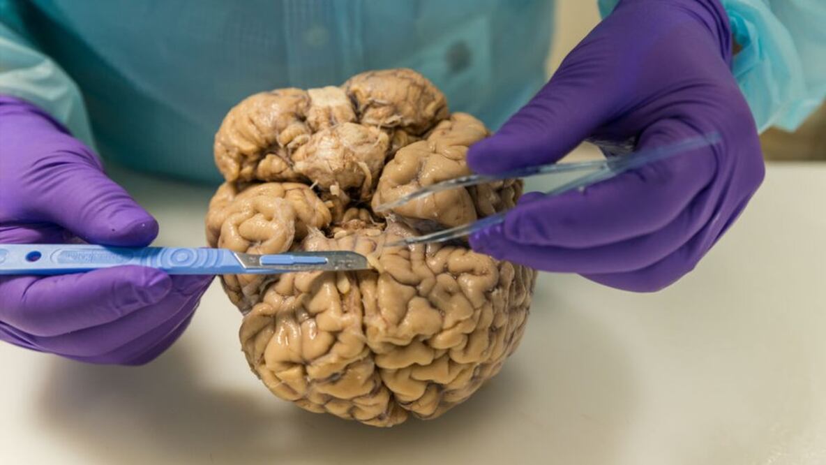 Ya no hay que esperar a morir para donar el cerebro a la ciencia. Foto: Getty Images vía BBC