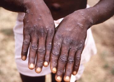 OMS investiga si rápida propagación de la viruela del mono se debe a mutaciones