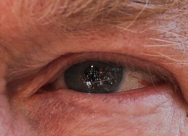 Descubren anomalías en ojos de pacientes graves de covid-19