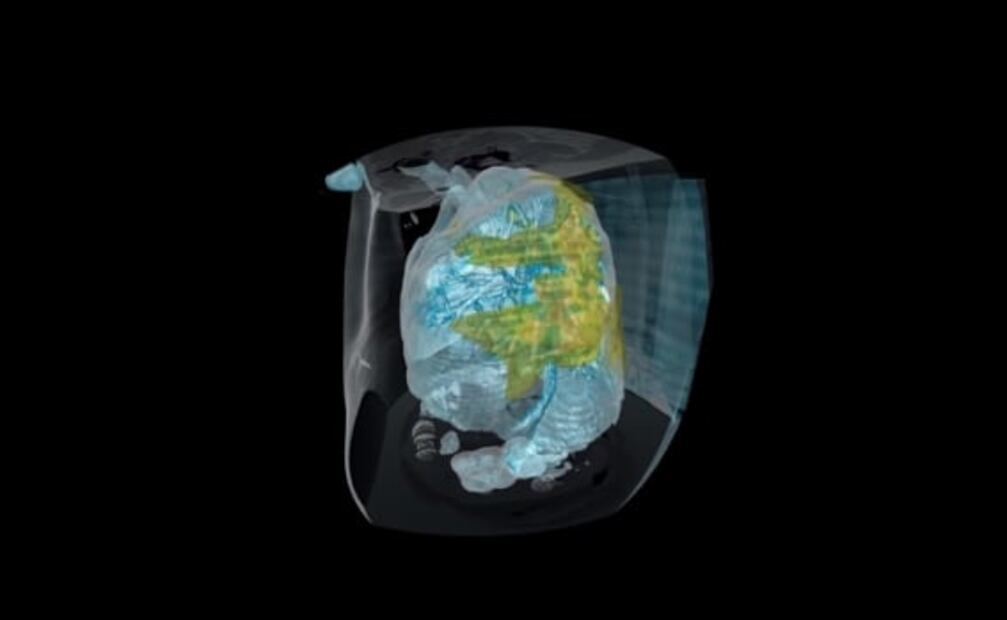 Así se ve el daño del Covid-19 en los pulmones