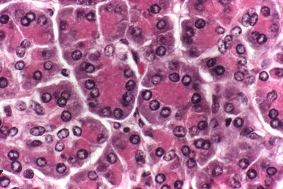 Cáncer de páncreas, el más letal y difícil de diagnosticar 