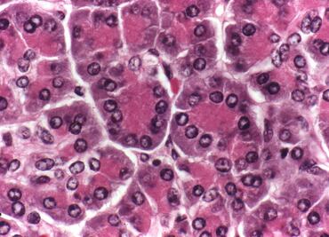 Cáncer de páncreas, el más letal y difícil de diagnosticar