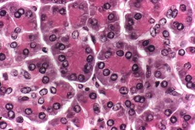 Cáncer de páncreas, el más letal y difícil de diagnosticar