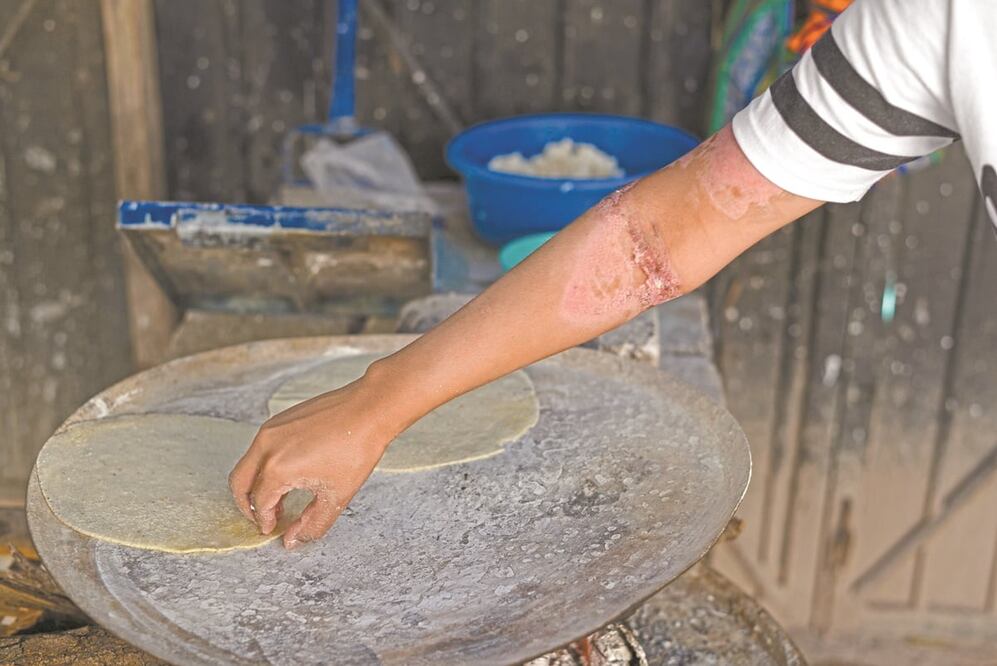A Xóchitl, las cicatrices aún le duelen y, a veces, la comezón invade su cuerpo. Fotos: Salvador Cisneros/ El Universal