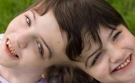 Krista y Tatiana: las siamesas que no sólo comparten el cerebro, sino también los pensamientos