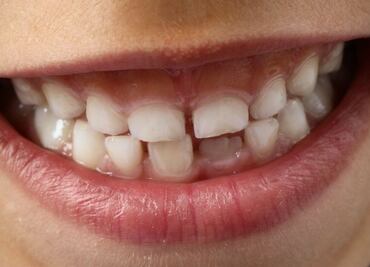 El desecho alimenticio que ayuda a la remineralización de los dientes