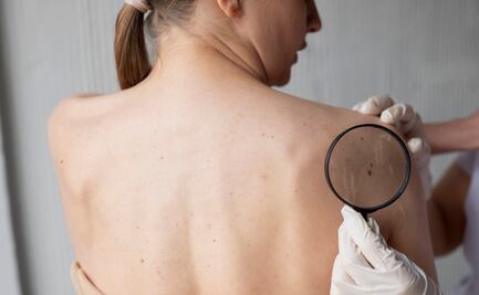 Cómo realizar tu autoexamen de piel