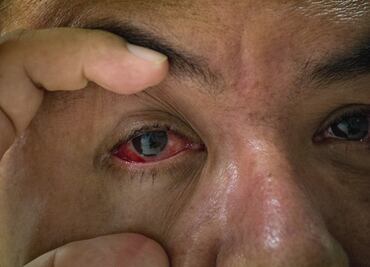 Durante la canícula, especialistas sugieren aseo de párpados