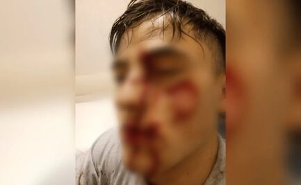 “No sé ni qué hice, me cegué”: joven ataca con una copa rota a novio de su ex al verlos juntos