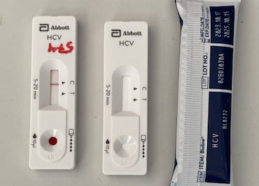 Día Mundial contra la Hepatitis: ¿Dónde puedes hacerte una prueba rápida en CDMX?