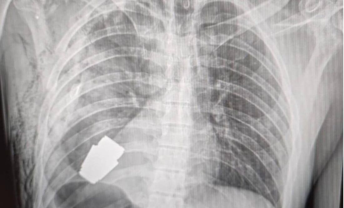 Una radiografía muestra lo cerca que se econtraba la granada del corazón del soldado ucraniano. Foto: Hanna Maliar Facebook