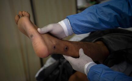 Expertos británicos presentan ensayo de tratamiento para la viruela del mono