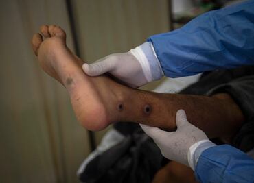 Expertos británicos presentan ensayo de tratamiento para la viruela del mono