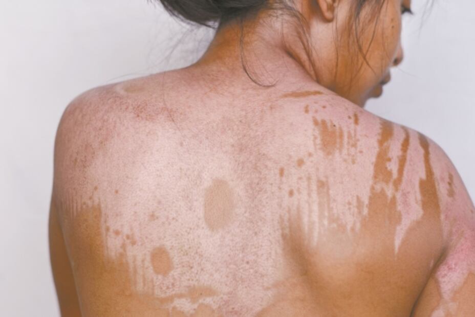 Agresor la quemó con agua; "no es delito", le dijeron en el MP