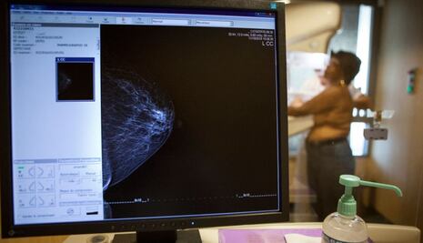 Inteligencia artificial "supera a médicos" en el diagnóstico de cáncer de mama