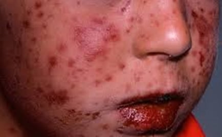 Cierran temporalmente 12 escuelas de Oaxaca por coxsackie