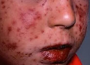 Cierran temporalmente 12 escuelas de Oaxaca por coxsackie