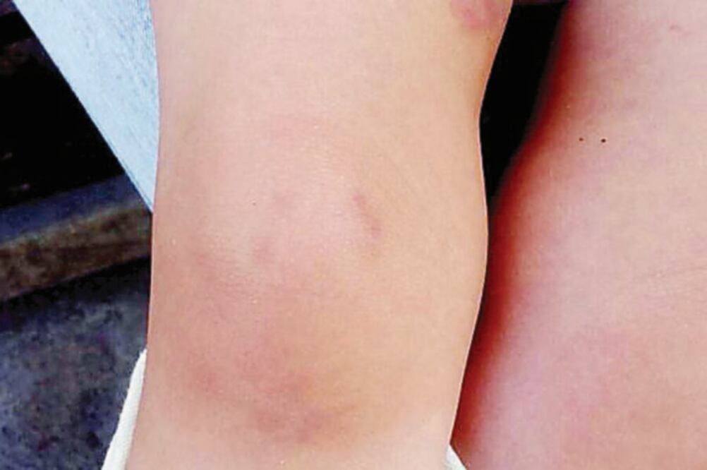 El pequeño de un año de edad presenta lesiones y marcas de dentadura en las extremidades y la cara (ESPECIAL)