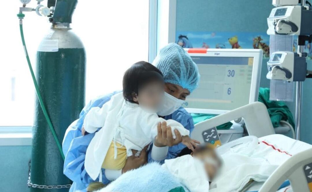 Unos gemelos siameses que nacieron unidos por el vientre fueron operados con éxito en el Hospital San Bartolomé de Lima. Foto: EFE