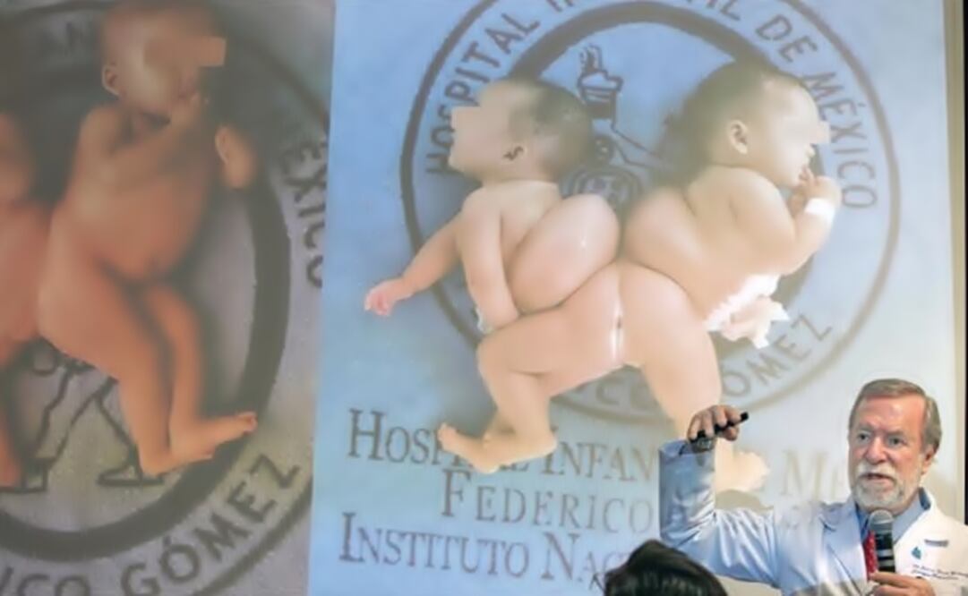 Doctors explained the surgery done on the baby girls in the Children Hospital of Mexico. (Photo: Valente Rosas/EL UNIVERSAL)