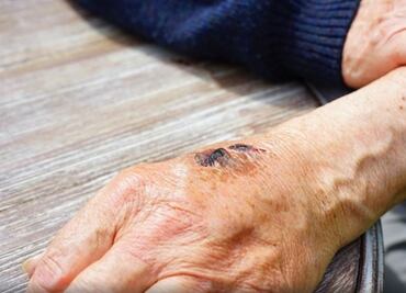 ¿Por qué las heridas tardan más en curarse con la edad?