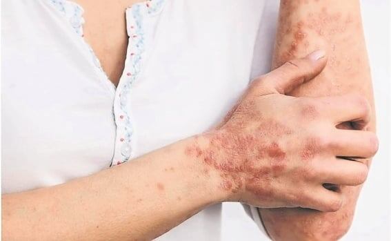 Reportan el primer caso de mpox en Asia y Europa. Foto: archivo