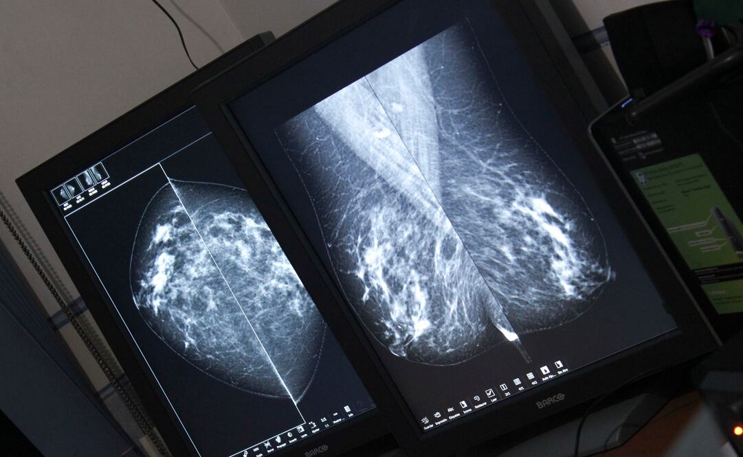 Prevé ISSSTE brindar 3 mil 300 mastografías antes de 2018