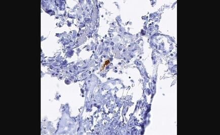 Identifican nueva vía de muerte cerebral en el Alzheimer