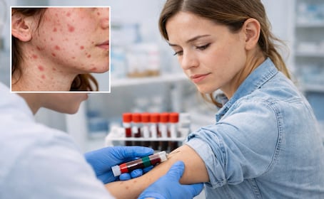 ¿Cómo saber si ya me dio sarampión? Esta es la prueba que revela si eres inmune 