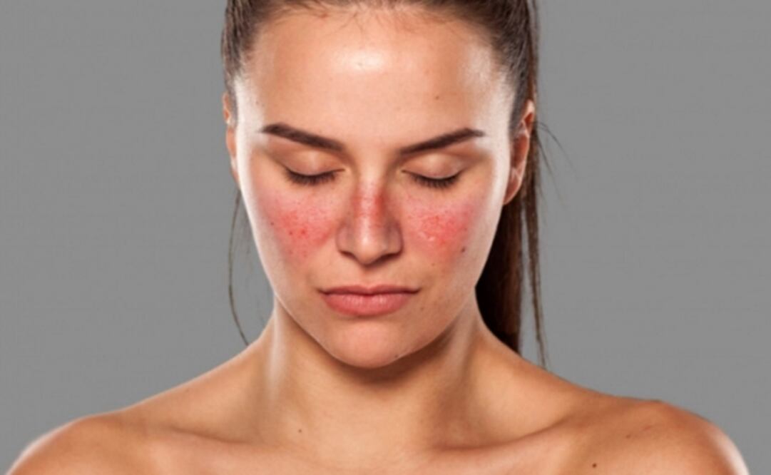 El lupus es de dos a tres veces más común en las mujeres. (Foto: Especial)