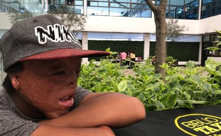 Juanito busca que con nueva cirugía le reconstruyan su mano