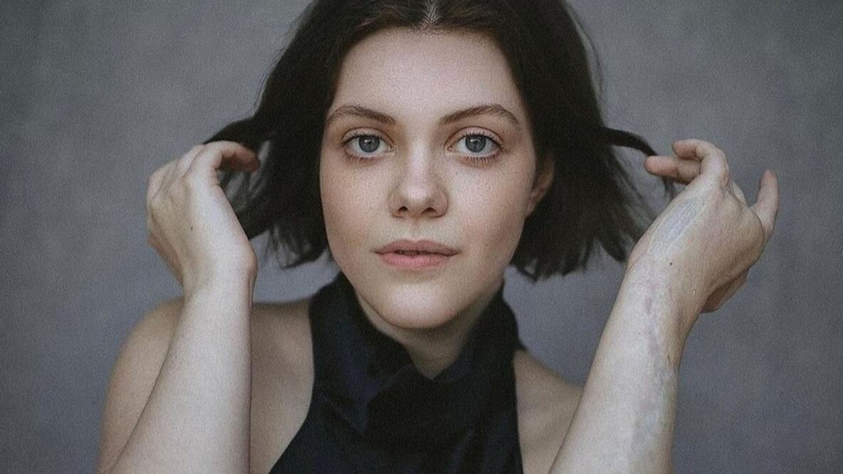 Georgie Henley, actriz de "Las Crónicas de Narnia", revela que sufrió fascitis necrosante y muestra por primera vez sus cicatrices